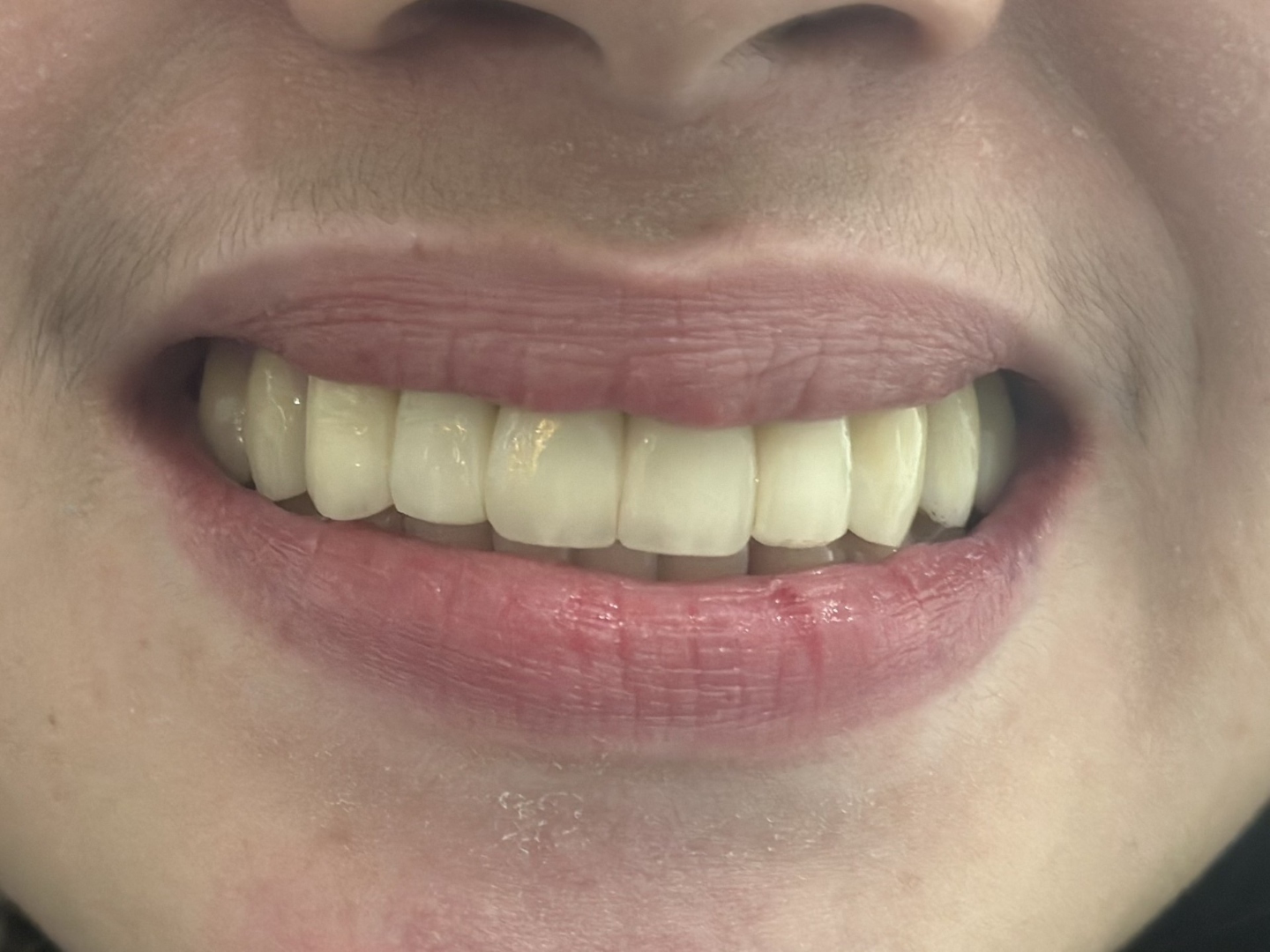 After crown and bridge treatment