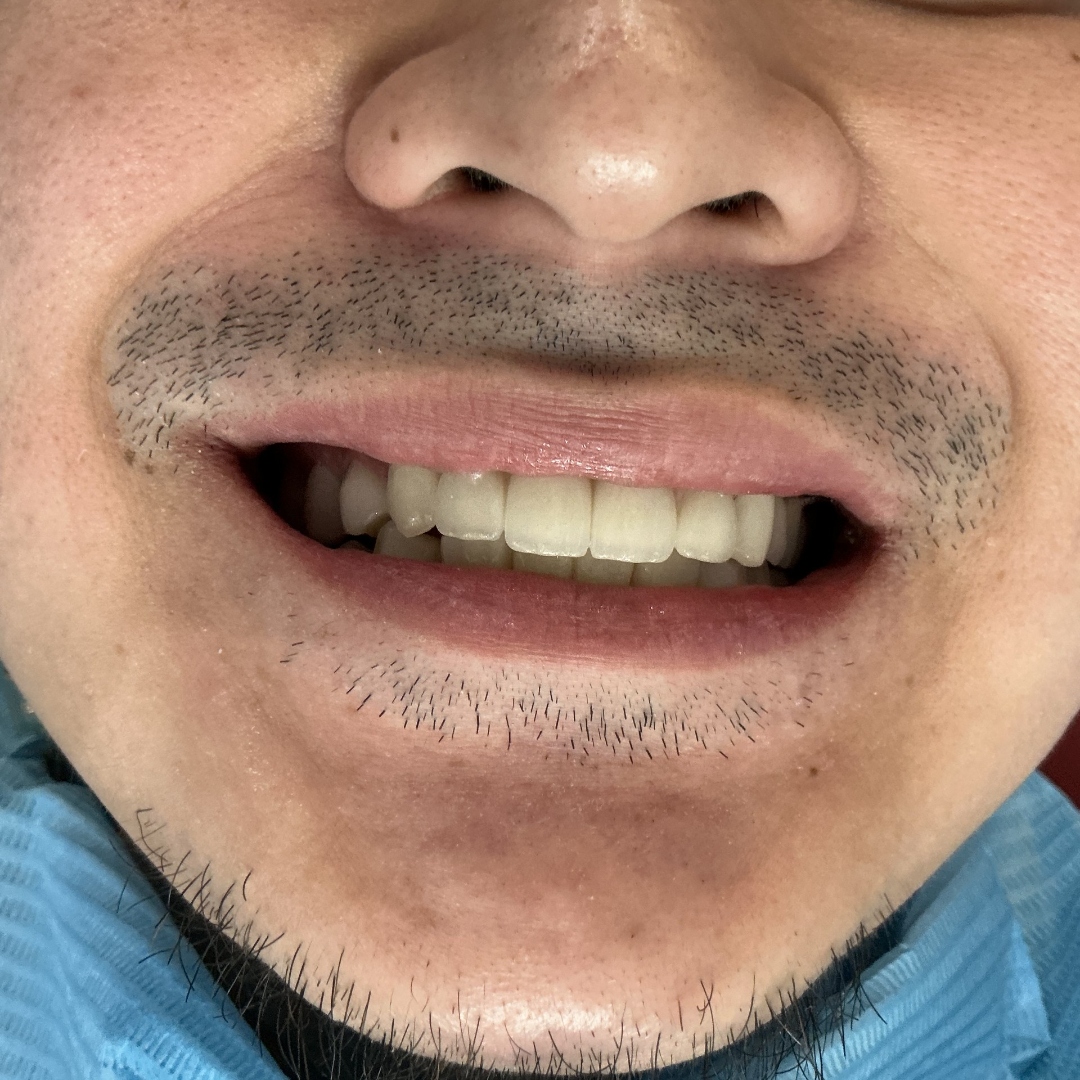 After smile makeover