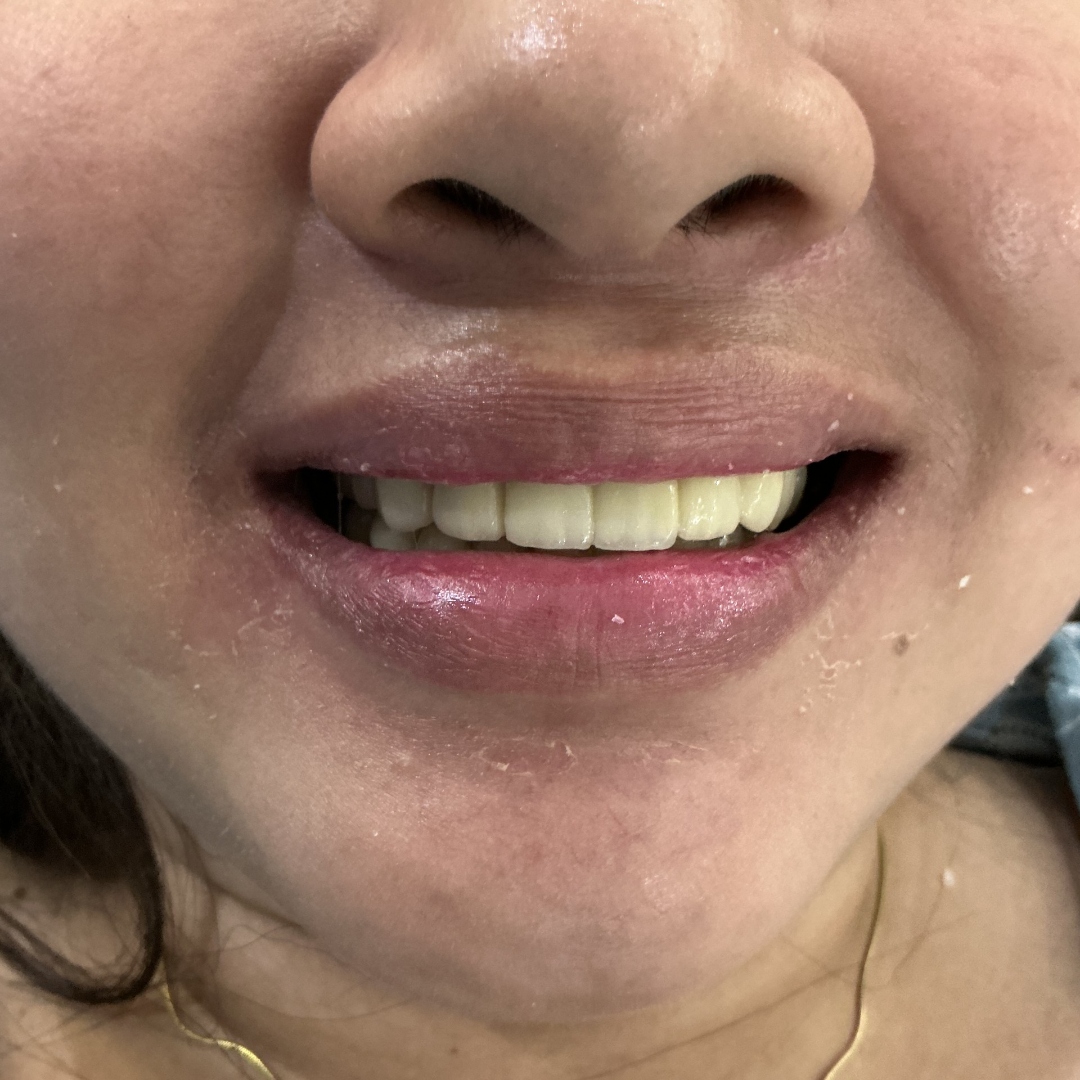 After crown and bridge treatment