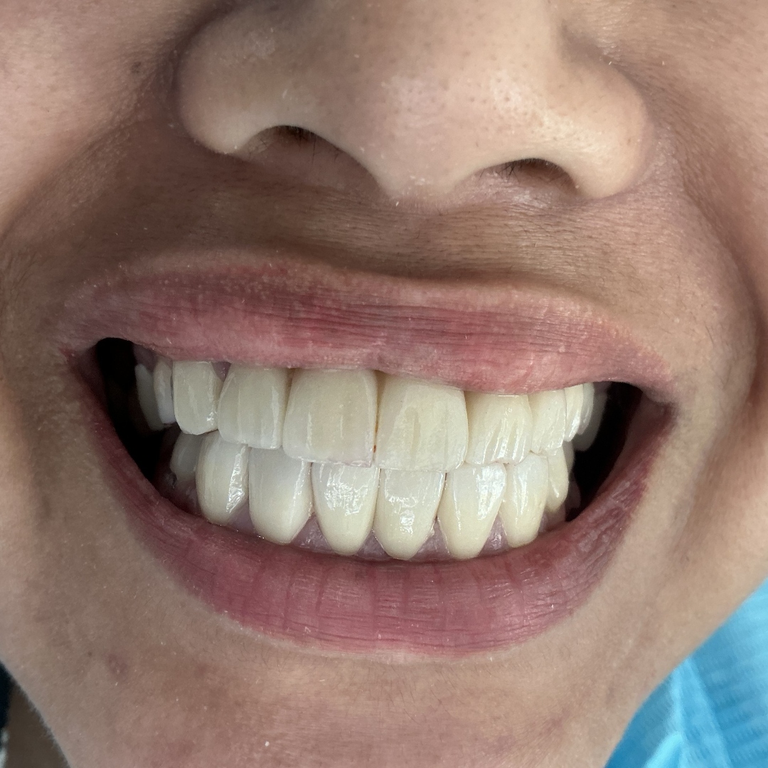 After smile makeover