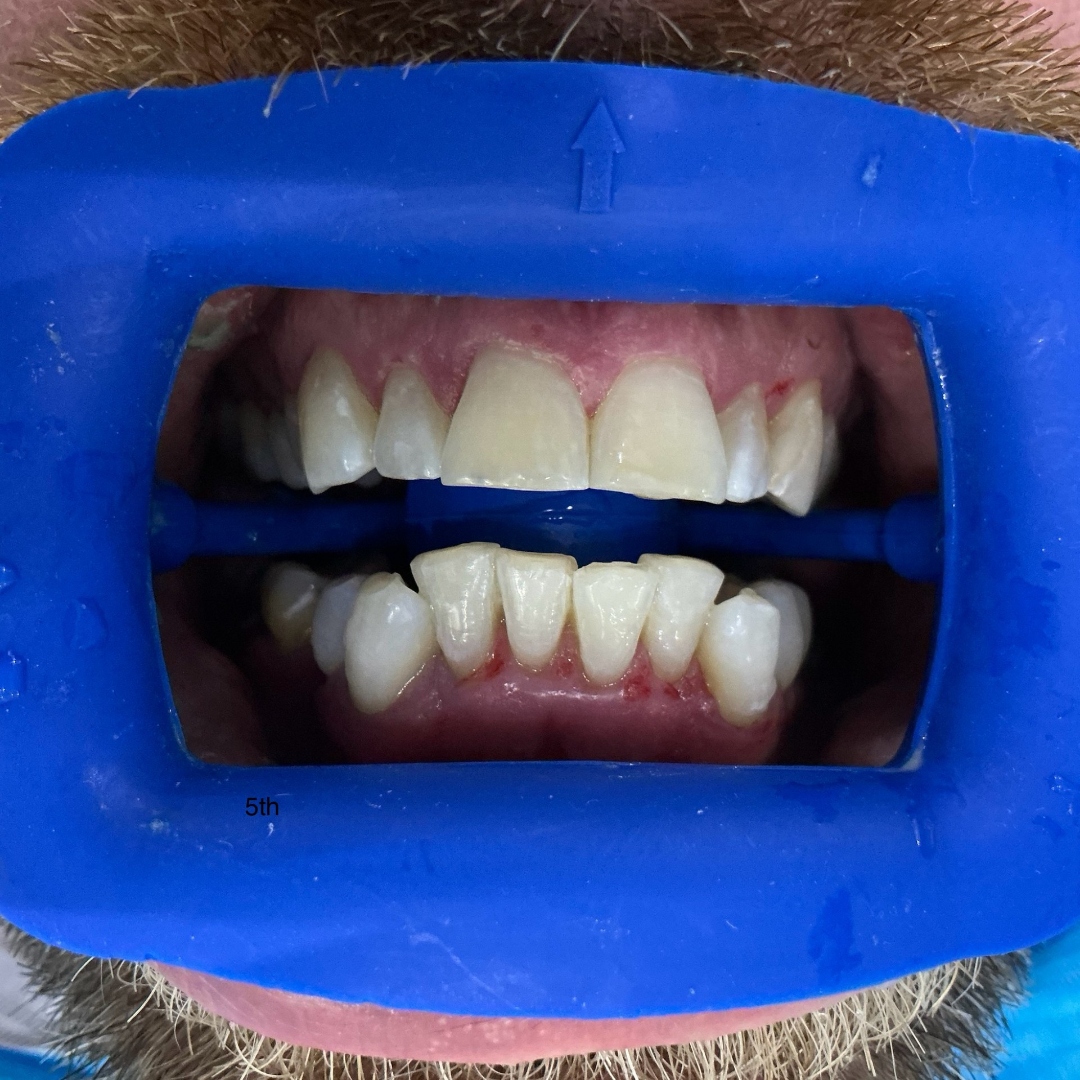 After teeth whitening