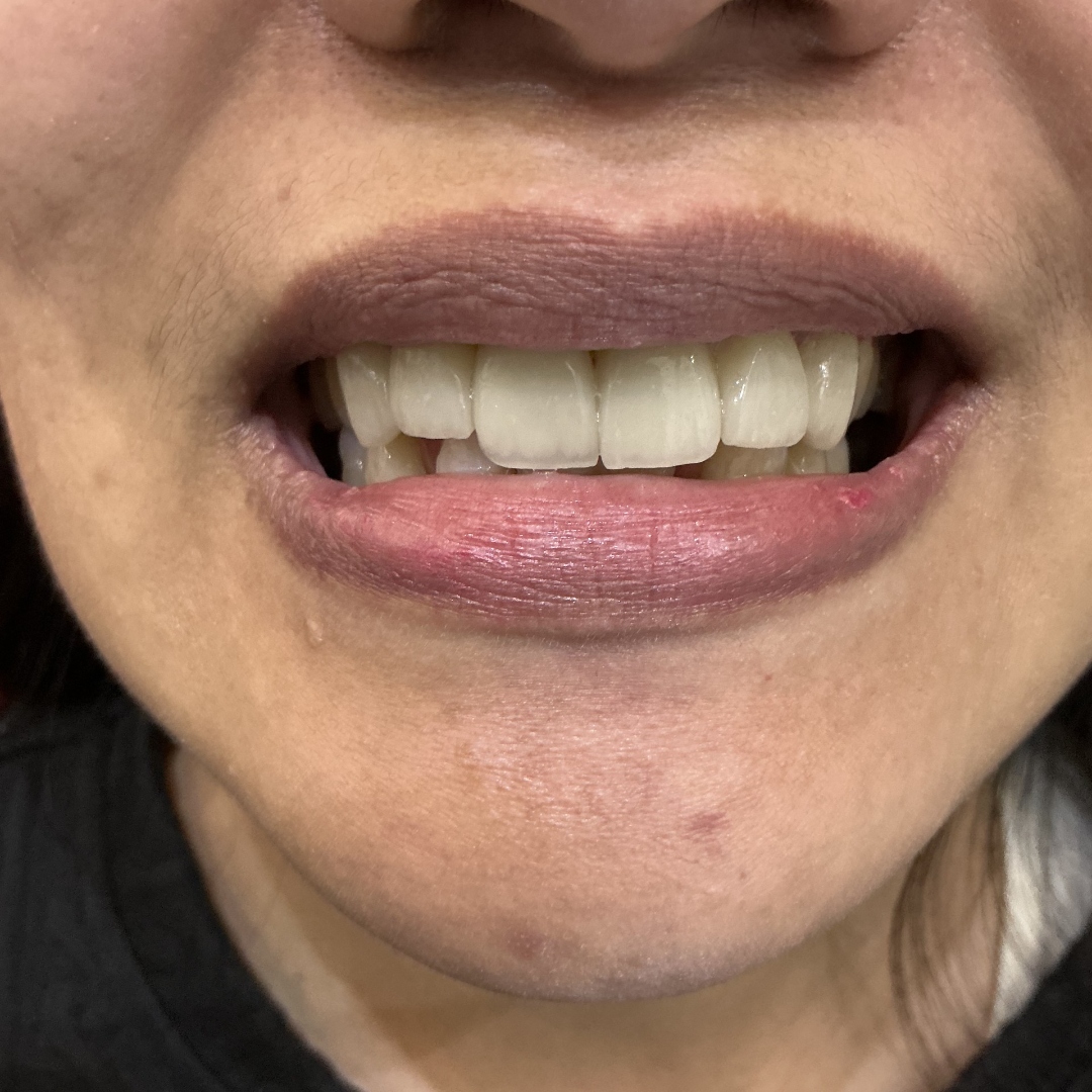 After veneers treatment