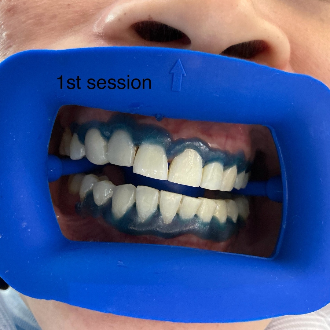 After teeth whitening