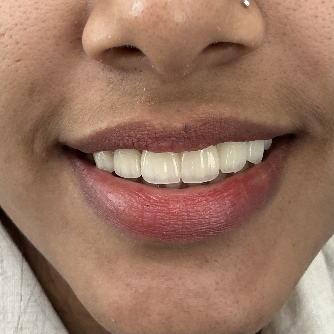 After smile makeover