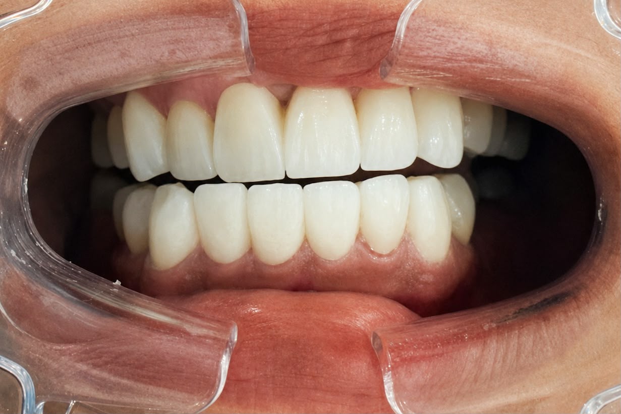 After veneers treatment