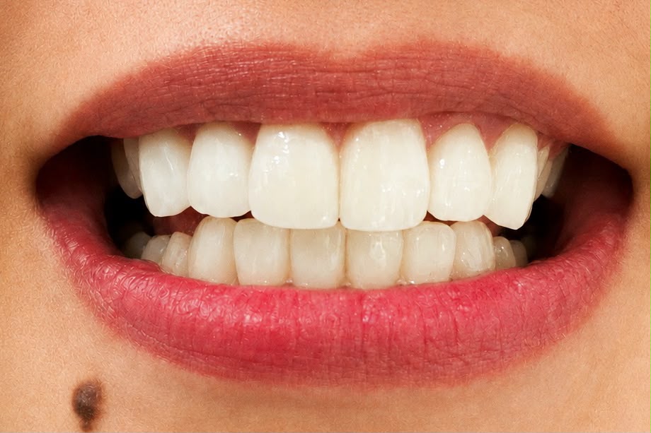 After veneers treatment