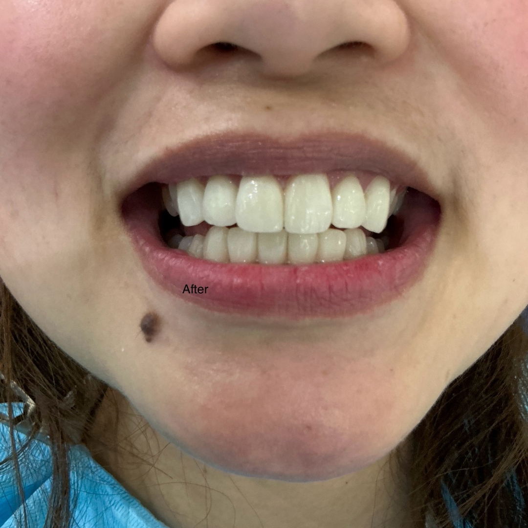 After veneers treatment