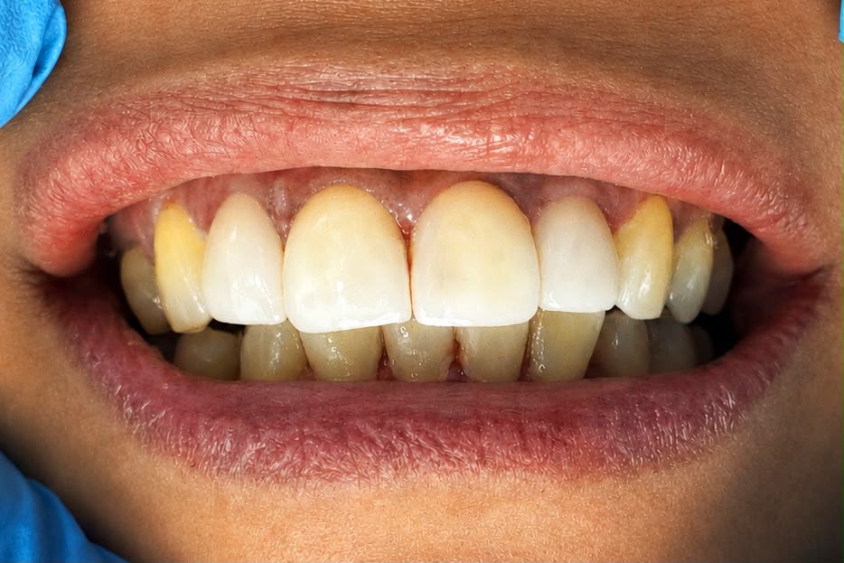 After veneers treatment