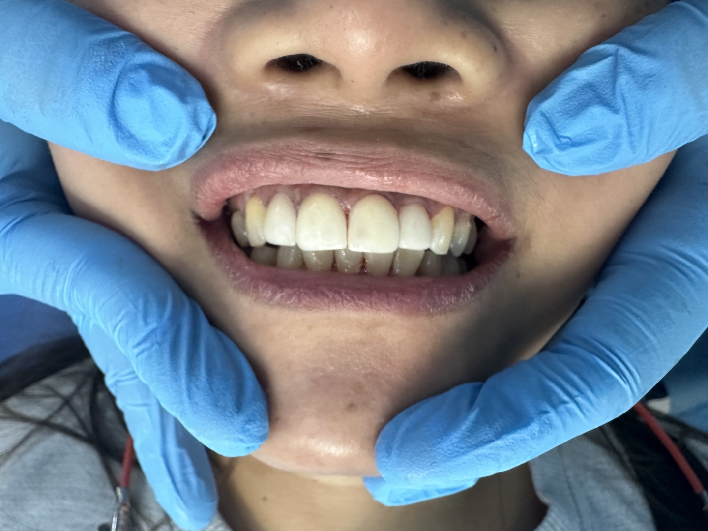 After veneers treatment