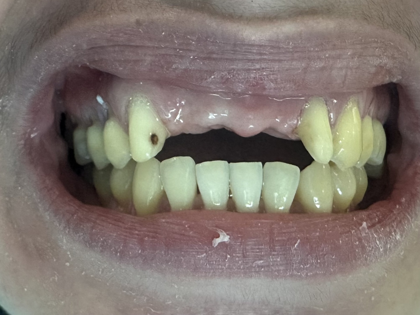 Before crown and bridge treatment