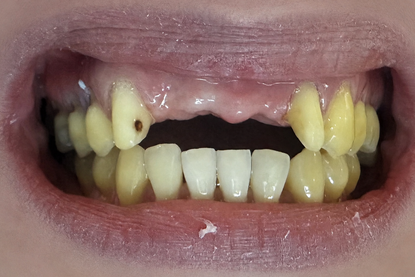 Before crown and bridge treatment