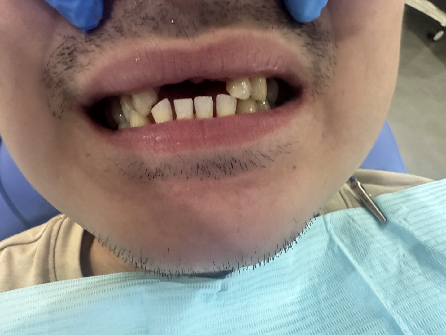 Before smile makeover