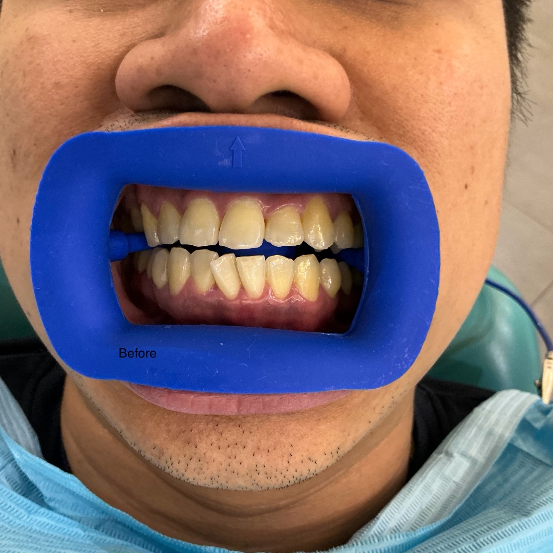 Before teeth whitening