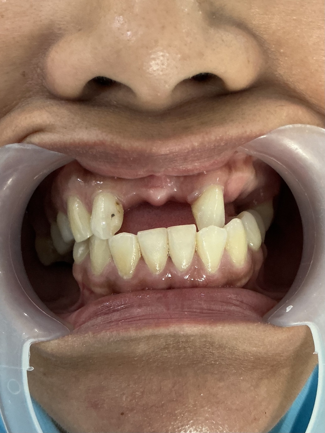 Before smile makeover