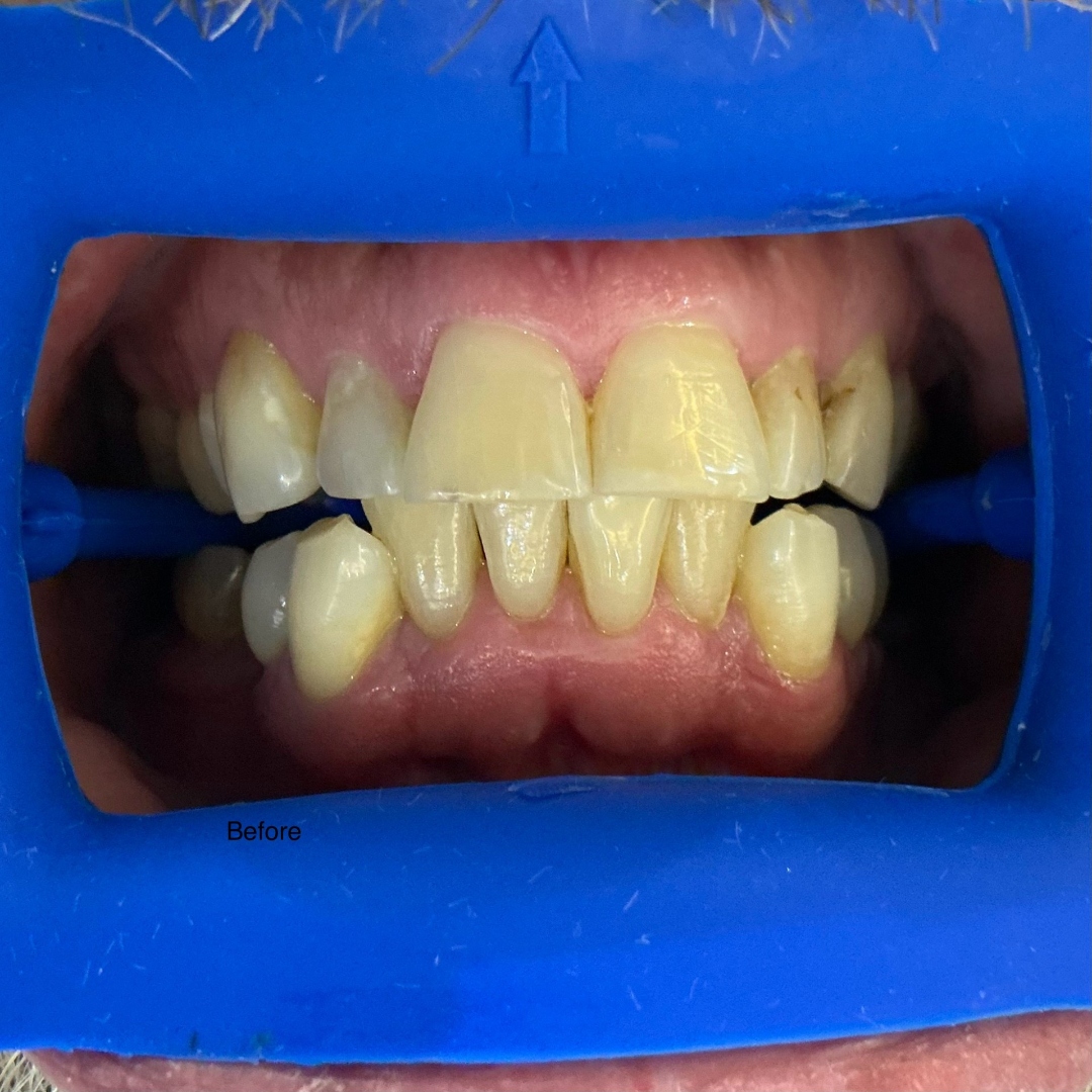 Before teeth whitening