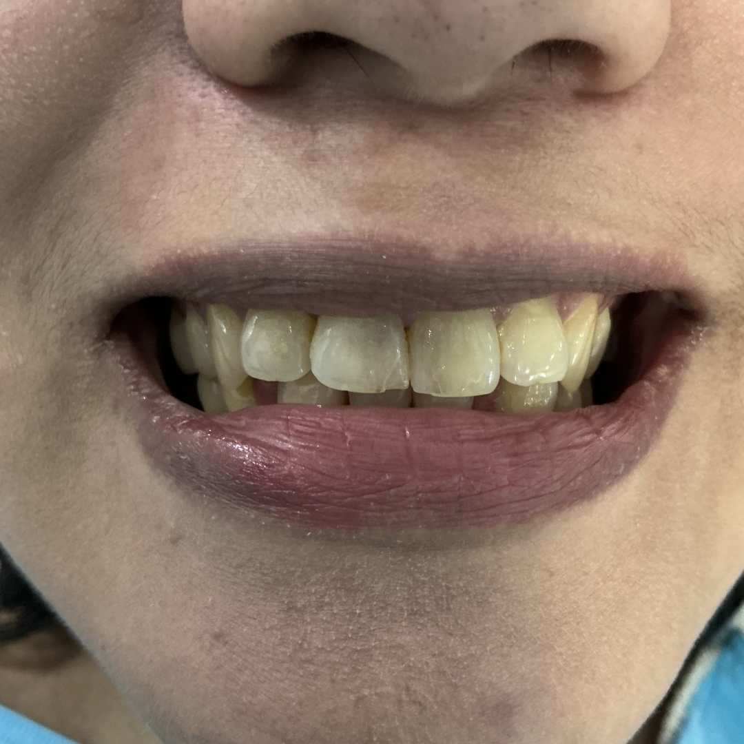 Before veneers treatment