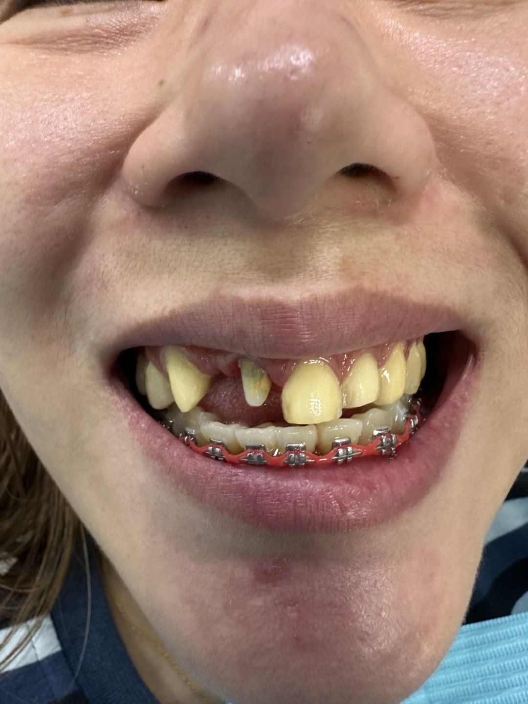 Before crown and bridge treatment