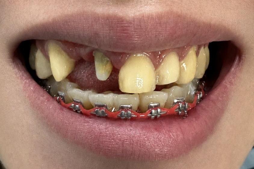 Before crown and bridge treatment
