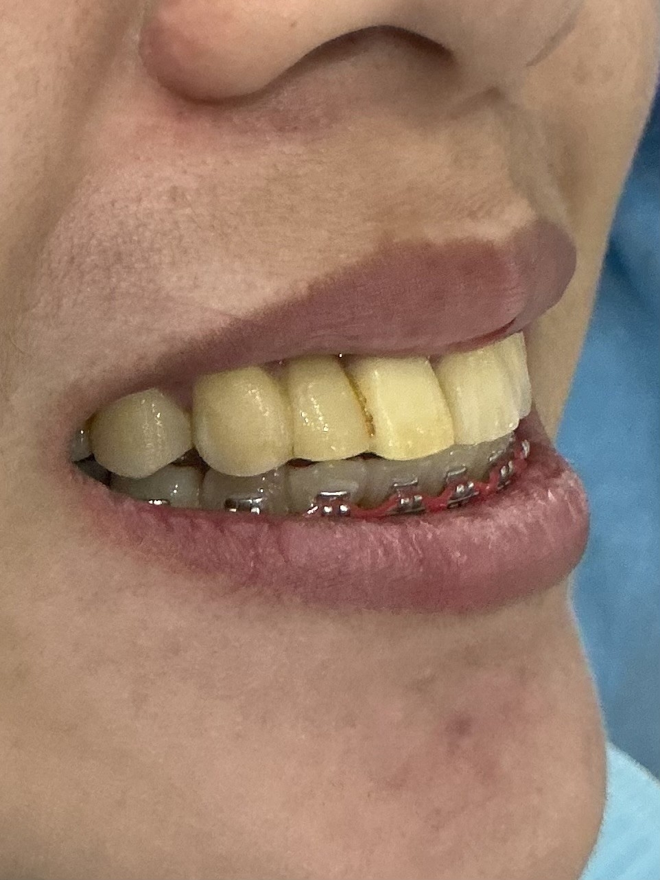 Before smile makeover