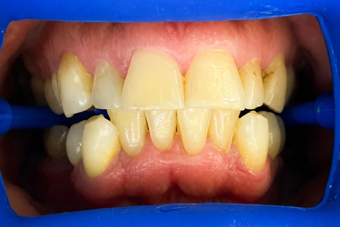 Before teeth whitening