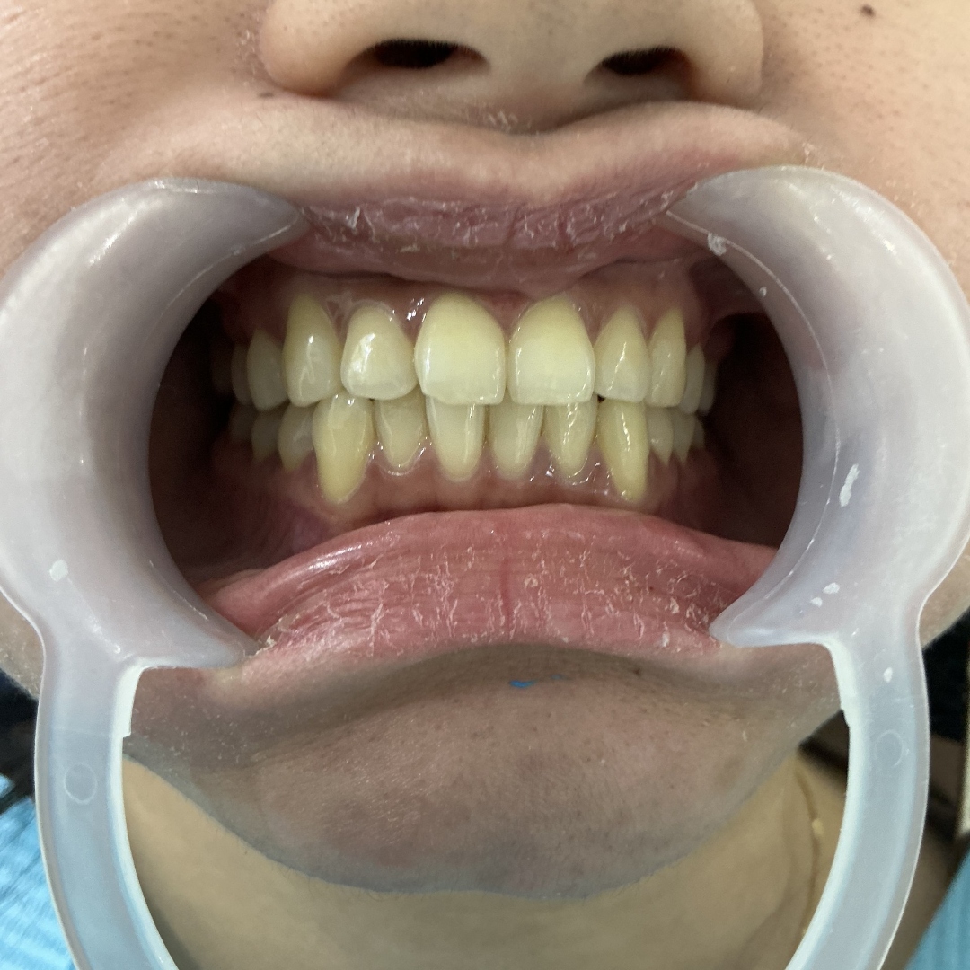 Before veneers treatment