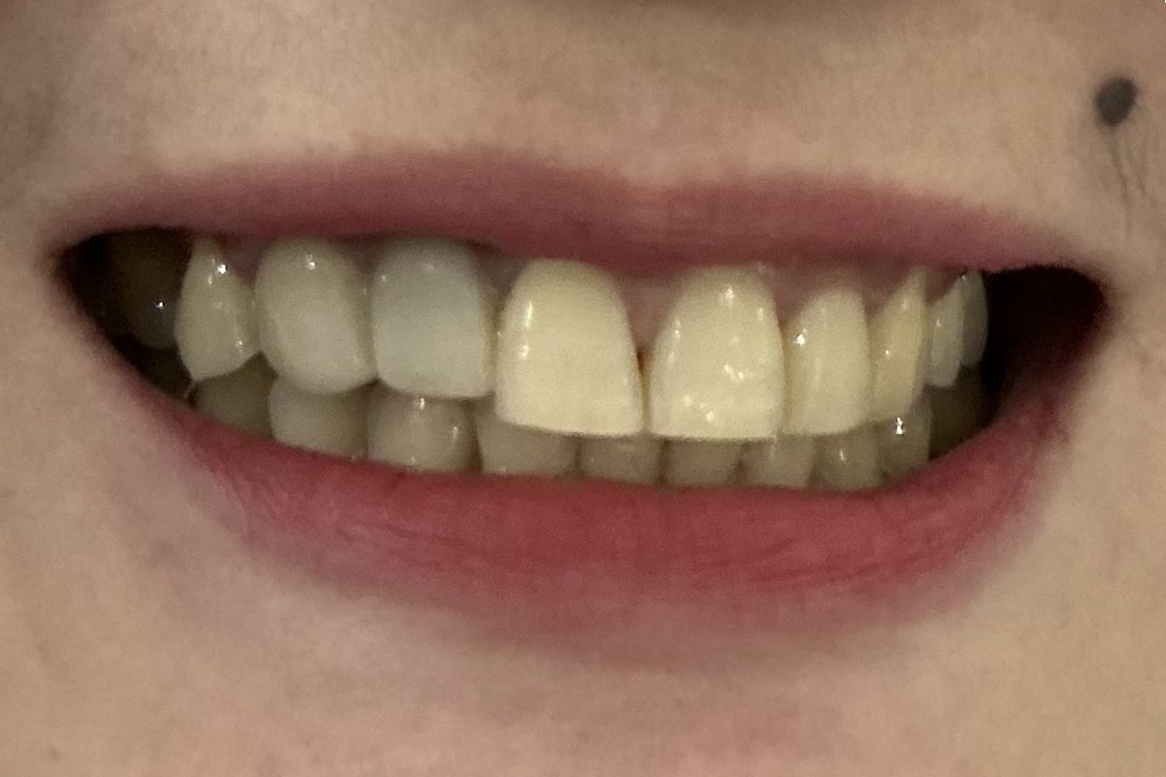 Before smile makeover