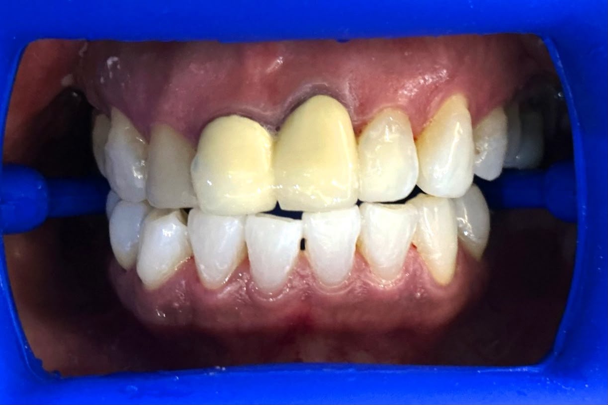 Before veneers treatment