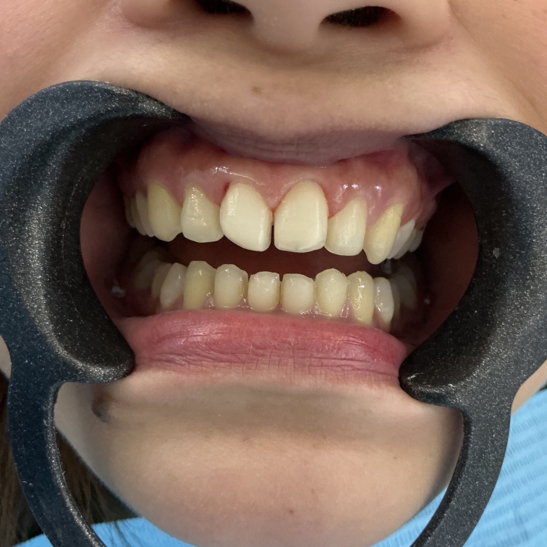 Before veneers treatment